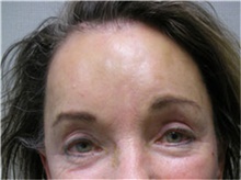 Brow Lift After Photo by Mariam Awada, MD, FACS; Southfield, MI - Case 38881
