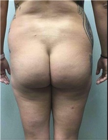 Buttock Lift with Augmentation Before Photo by Mariam Awada, MD, FACS; Southfield, MI - Case 38885