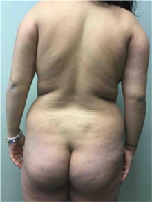 Buttock Lift with Augmentation Before Photo by Mariam Awada, MD, FACS; Southfield, MI - Case 38887