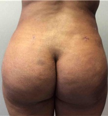 Buttock Lift with Augmentation After Photo by Mariam Awada, MD, FACS; Southfield, MI - Case 38888