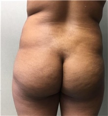 Buttock Lift with Augmentation Before Photo by Mariam Awada, MD, FACS; Southfield, MI - Case 38888