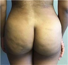 Buttock Lift with Augmentation After Photo by Mariam Awada, MD, FACS; Southfield, MI - Case 38890
