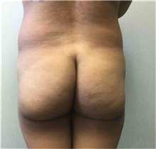 Buttock Lift with Augmentation Before Photo by Mariam Awada, MD, FACS; Southfield, MI - Case 38890