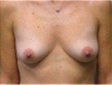 Breast Augmentation Before Photo by Mariam Awada, MD, FACS; Southfield, MI - Case 40118