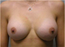 Breast Augmentation After Photo by Mariam Awada, MD, FACS; Southfield, MI - Case 40119