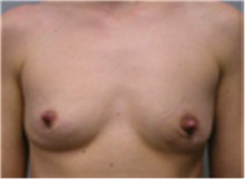 Breast Augmentation Before Photo by Mariam Awada, MD, FACS; Southfield, MI - Case 40119