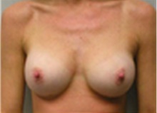 Breast Augmentation After Photo by Mariam Awada, MD, FACS; Southfield, MI - Case 40120