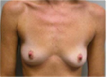 Breast Augmentation Before Photo by Mariam Awada, MD, FACS; Southfield, MI - Case 40120