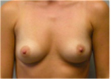Breast Augmentation Before Photo by Mariam Awada, MD, FACS; Southfield, MI - Case 40121