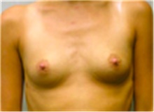 Breast Augmentation Before Photo by Mariam Awada, MD, FACS; Southfield, MI - Case 40122