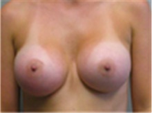 Breast Augmentation After Photo by Mariam Awada, MD, FACS; Southfield, MI - Case 40123