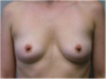 Breast Augmentation Before Photo by Mariam Awada, MD, FACS; Southfield, MI - Case 40123