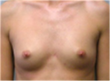 Breast Augmentation Before Photo by Mariam Awada, MD, FACS; Southfield, MI - Case 40124