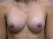 Breast Augmentation After Photo by Mariam Awada, MD, FACS; Southfield, MI - Case 40125