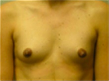 Breast Augmentation Before Photo by Mariam Awada, MD, FACS; Southfield, MI - Case 40125