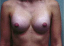 Breast Augmentation After Photo by Mariam Awada, MD, FACS; Southfield, MI - Case 40126