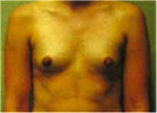 Breast Augmentation Before Photo by Mariam Awada, MD, FACS; Southfield, MI - Case 40126