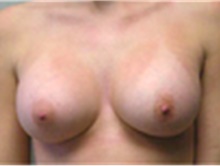 Breast Augmentation After Photo by Mariam Awada, MD, FACS; Southfield, MI - Case 40127