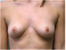 Breast Augmentation Before Photo by Mariam Awada, MD, FACS; Southfield, MI - Case 40127