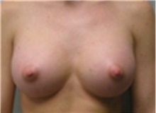 Breast Augmentation After Photo by Mariam Awada, MD, FACS; Southfield, MI - Case 40128