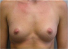 Breast Augmentation Before Photo by Mariam Awada, MD, FACS; Southfield, MI - Case 40128