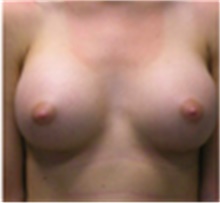 Breast Augmentation After Photo by Mariam Awada, MD, FACS; Southfield, MI - Case 40129