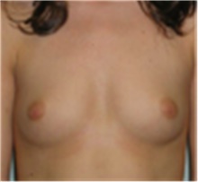 Breast Augmentation Before Photo by Mariam Awada, MD, FACS; Southfield, MI - Case 40129