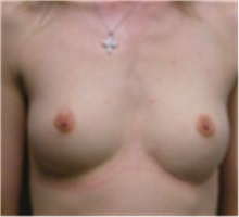 Breast Augmentation Before Photo by Mariam Awada, MD, FACS; Southfield, MI - Case 40130