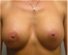 Breast Augmentation After Photo by Mariam Awada, MD, FACS; Southfield, MI - Case 40131