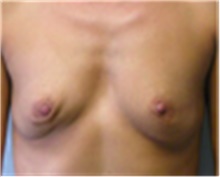 Breast Augmentation Before Photo by Mariam Awada, MD, FACS; Southfield, MI - Case 40131