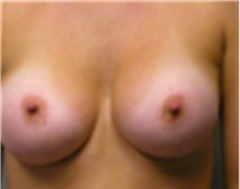 Breast Augmentation After Photo by Mariam Awada, MD, FACS; Southfield, MI - Case 40132