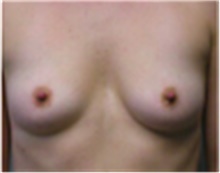 Breast Augmentation Before Photo by Mariam Awada, MD, FACS; Southfield, MI - Case 40132