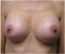 Breast Augmentation After Photo by Mariam Awada, MD, FACS; Southfield, MI - Case 40133