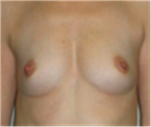 Breast Augmentation Before Photo by Mariam Awada, MD, FACS; Southfield, MI - Case 40133