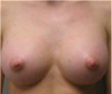 Breast Augmentation After Photo by Mariam Awada, MD, FACS; Southfield, MI - Case 40134
