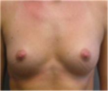 Breast Augmentation Before Photo by Mariam Awada, MD, FACS; Southfield, MI - Case 40134