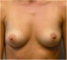Breast Augmentation Before Photo by Mariam Awada, MD, FACS; Southfield, MI - Case 40135