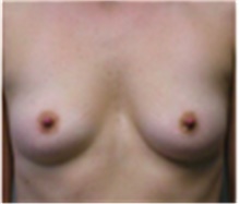 Breast Augmentation Before Photo by Mariam Awada, MD, FACS; Southfield, MI - Case 40136
