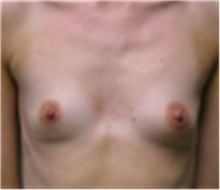 Breast Augmentation Before Photo by Mariam Awada, MD, FACS; Southfield, MI - Case 40139
