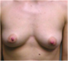 Breast Augmentation Before Photo by Mariam Awada, MD, FACS; Southfield, MI - Case 40140