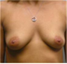 Breast Augmentation Before Photo by Mariam Awada, MD, FACS; Southfield, MI - Case 40141