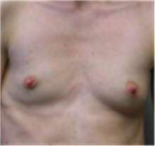 Breast Augmentation Before Photo by Mariam Awada, MD, FACS; Southfield, MI - Case 40142