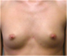 Breast Augmentation Before Photo by Mariam Awada, MD, FACS; Southfield, MI - Case 40143