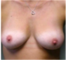 Breast Augmentation Before Photo by Mariam Awada, MD, FACS; Southfield, MI - Case 40144