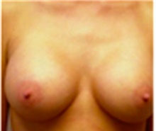 Breast Augmentation After Photo by Mariam Awada, MD, FACS; Southfield, MI - Case 40145