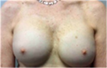 Breast Implant Removal After Photo by Mariam Awada, MD, FACS; Southfield, MI - Case 40147