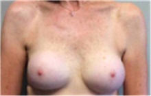 Breast Implant Removal Before Photo by Mariam Awada, MD, FACS; Southfield, MI - Case 40147