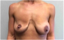 Breast Implant Removal Before Photo by Mariam Awada, MD, FACS; Southfield, MI - Case 40149