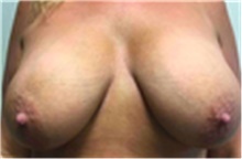 Breast Implant Removal Before Photo by Mariam Awada, MD, FACS; Southfield, MI - Case 40150