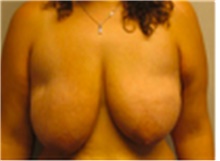 Breast Lift Before Photo by Mariam Awada, MD, FACS; Southfield, MI - Case 40154